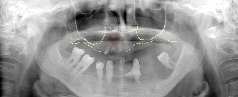 1 Na OPG snímku je zobrazen parodontitidou devastovaný chrup. V horní čelisti je extrémní nedostatek čelistní kosti pro možnou implantaci. Červená linka ohraničuje cystu, která vznikla nad infikovanými kořeny předních zubů.